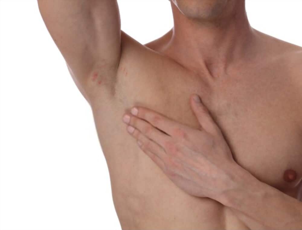 man armpit with irritation